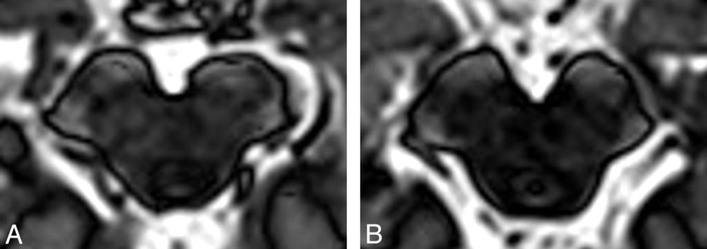 Parkinson Disease Structural abnormalities on MR imaging in PD are subtle and, other than nonspecific putaminal atrophy, are found in 20% of patients with PD.