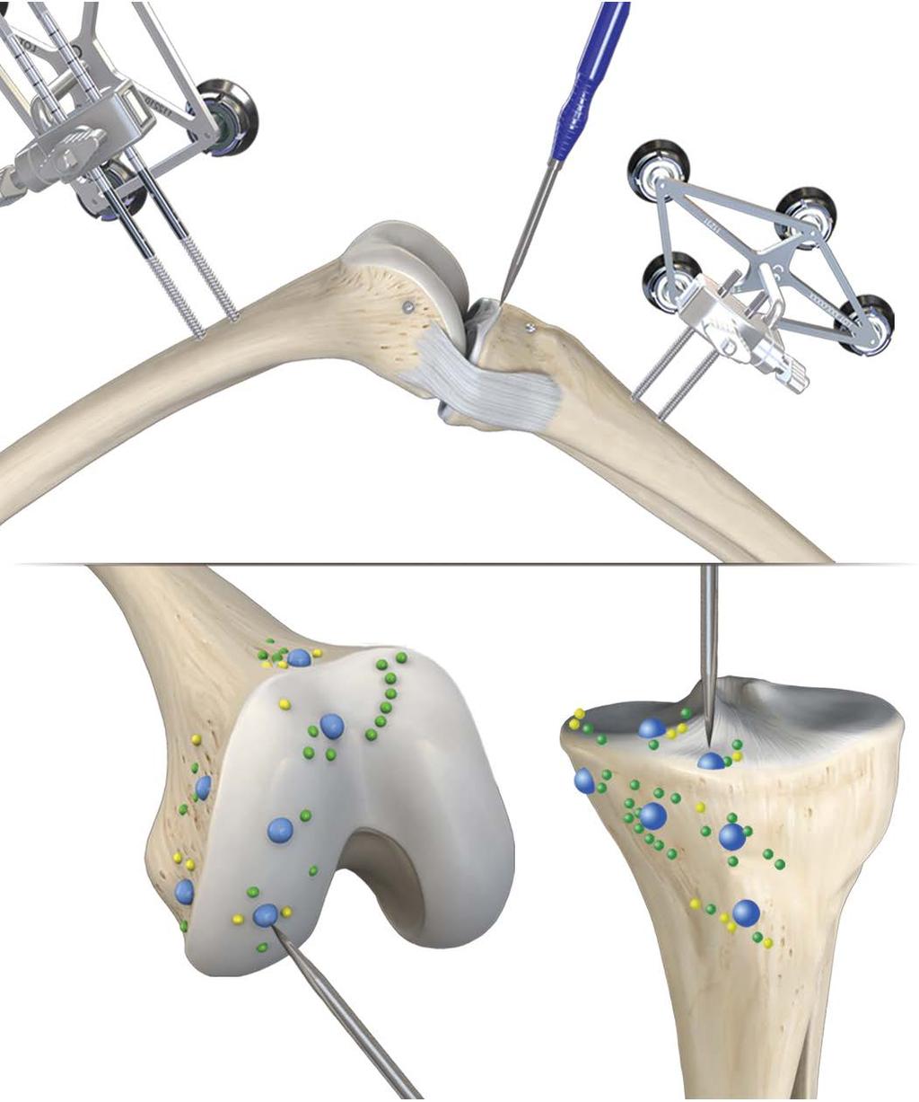 Bone registration and gap balancing Collect patient landmarks. Register and verify the femoral and tibial checkpoints.