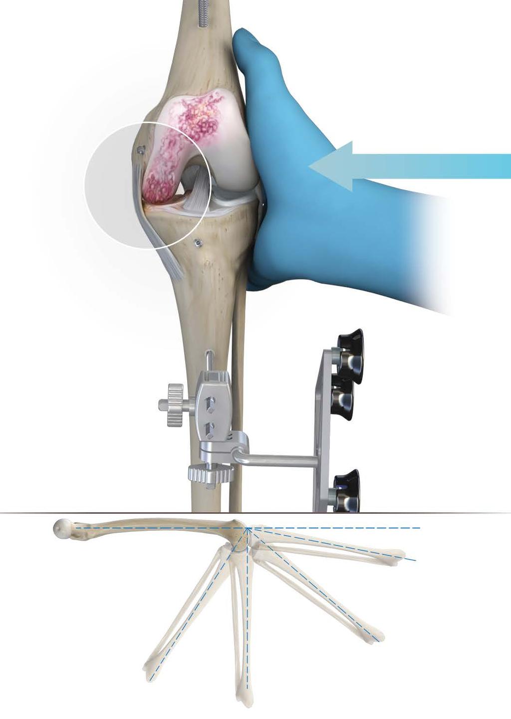 Femoral checkpoint Tibial checkpoint Figure 14 Exposed medial compartment Medial collateral ligament (MCL) Valgus stress applied Remove overhanging medial osteophytes and then capture a minimum of 4