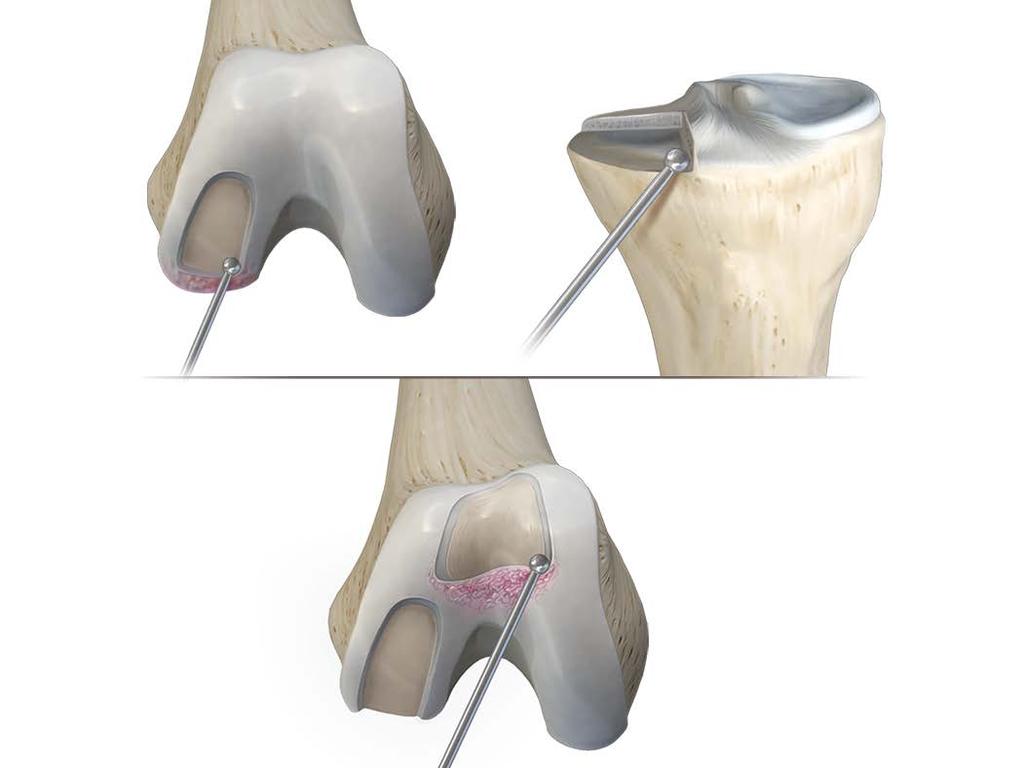 femoral component.