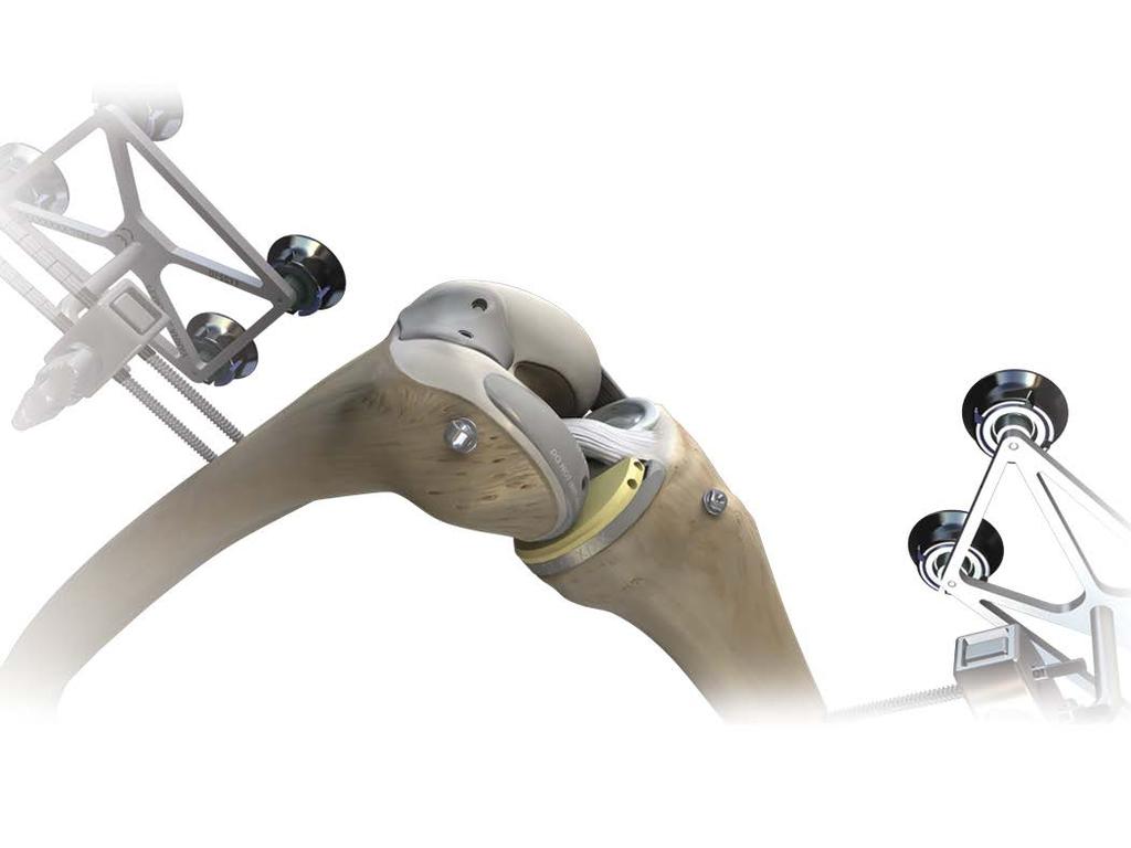 Trialing, soft tissue balancing and implant insertion Remove any meniscus and other soft tissues. Clean up the joint and install trial components.
