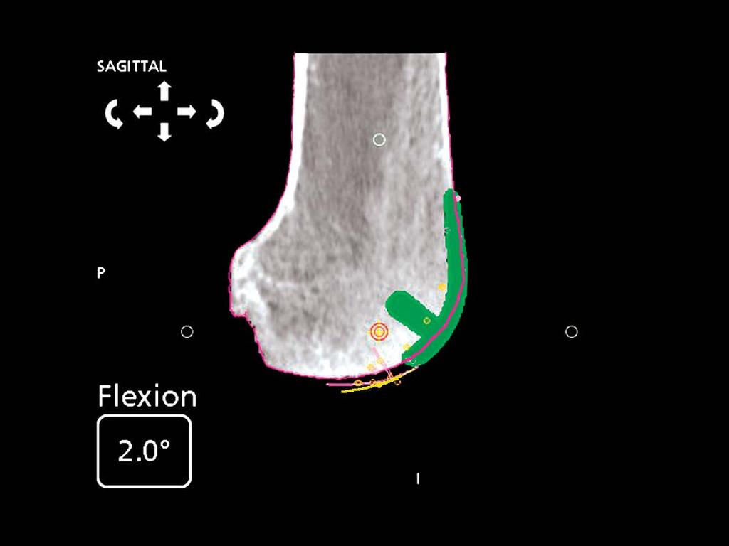 The mapped cartilage is represented as yellow lines.