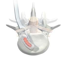 Position the implant in the inter-vertebral