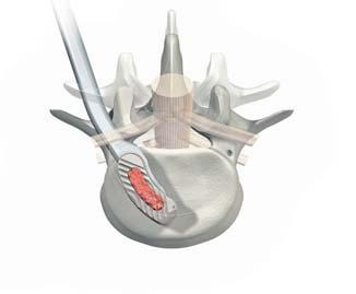 Loosen the impaction knob of the implant holder