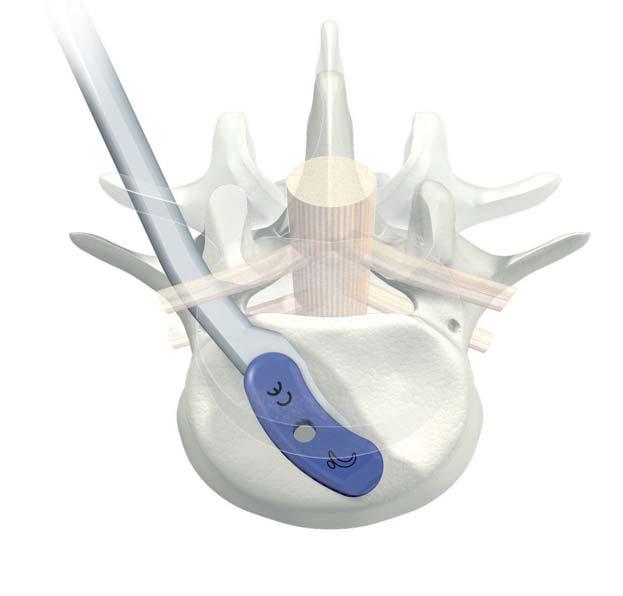 Insert the chosen trial implant into the inter-vertebral space as close as possible to the desired final position without removing the trial implant from the