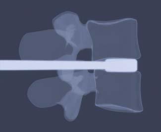 Check the correct positioning of the trial implant under X-Ray fluoroscopy.