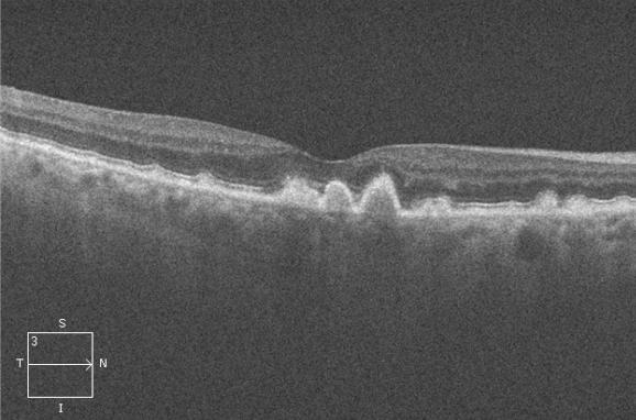 2 Retinal pigment epithelium (RPE) bumps A 42-year-old presents for the first time with complaints of having to move the computer back further to read fine print.