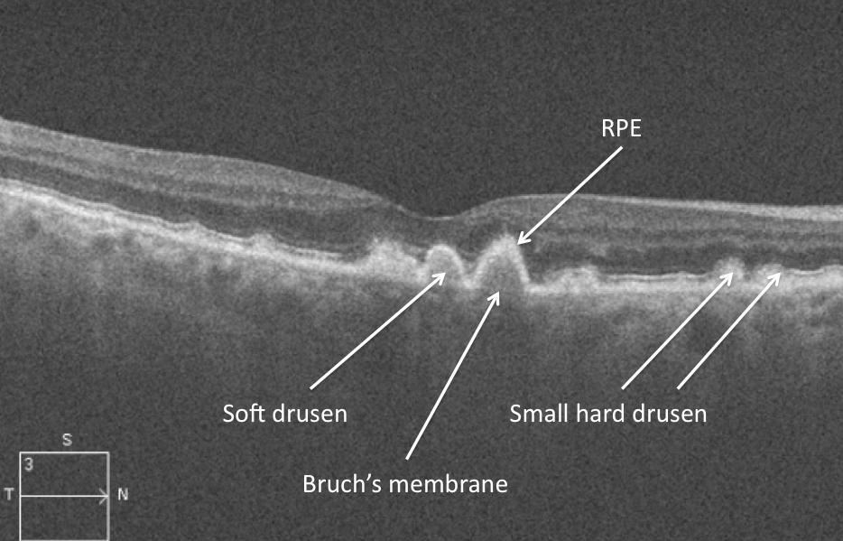 OCT Tip If you see bumps at the level of the RPE, drusen are usually present.