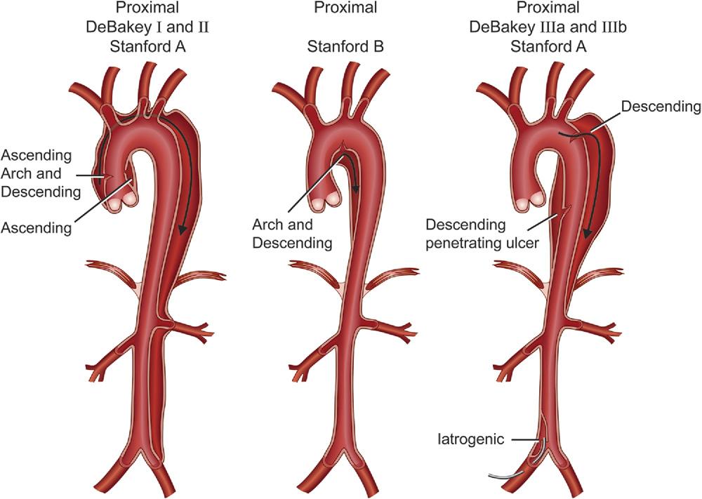 1530 Nienaber et al JOURNAL OF VASCULAR SURGERY November 2011 Fig 1. DeBakey and Stanford classifications of aortic dissection. Table I.