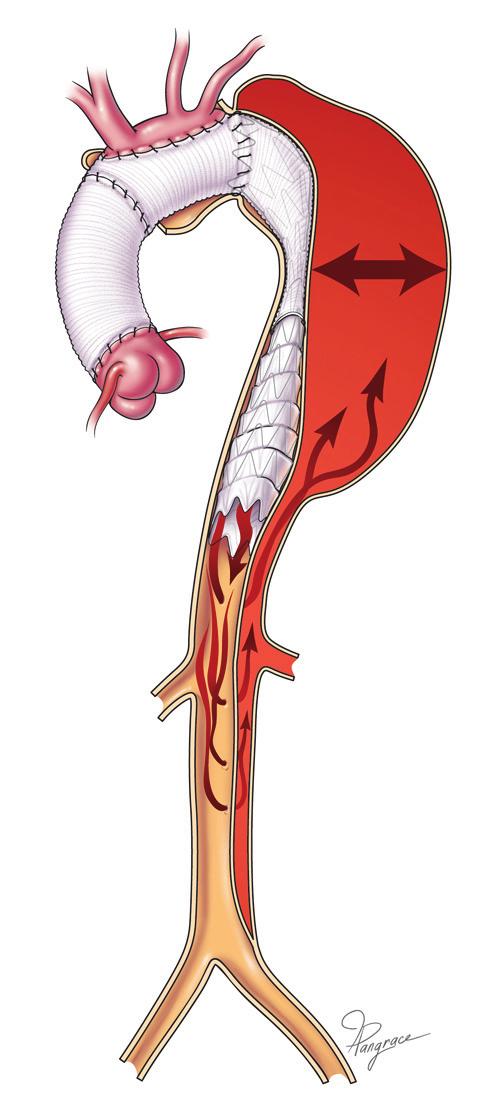 Endovascular therapy for descending thoracic aortic dissections Perspective Blount and Hagspiel reported that medical treatment of descending dissection was associated with progressive increase in