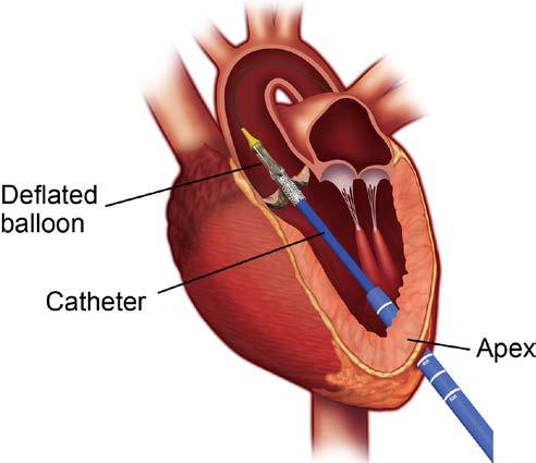 After your valve is opened, your surgeon will deflate the balloon and remove it from your ventricle. The catheter with the deflated balloon enters your heart through the apex.