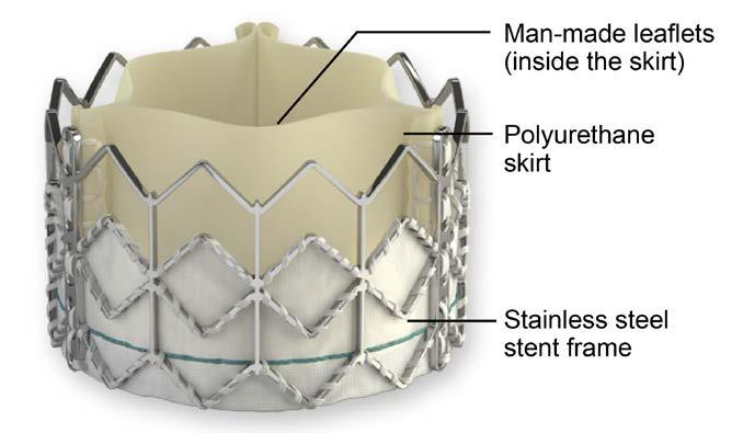 Inflate the balloon when it is inside the diseased aortic valve and put the man-made valve in place. The valve will expand to fill this space. Types of TAVR There are several ways to do TAVR.