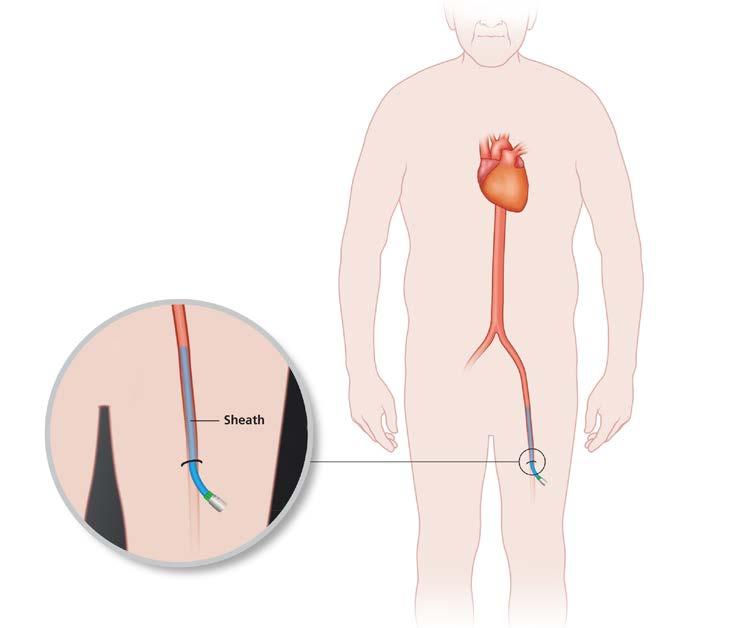 Transfemoral Aortic Valve Replacement A transfemoral aortic valve replacement is done through your femoral artery. This artery is in your upper leg or groin.