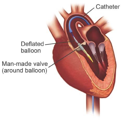 Crimped valve around the deflated balloon in your aortic valve. Next, your doctors will place the new heart valve around the deflated balloon.