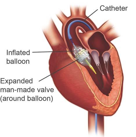 Using fluoroscopy X-ray to guide them, your doctors will move the balloon and valve through your femoral artery up into your aortic valve.