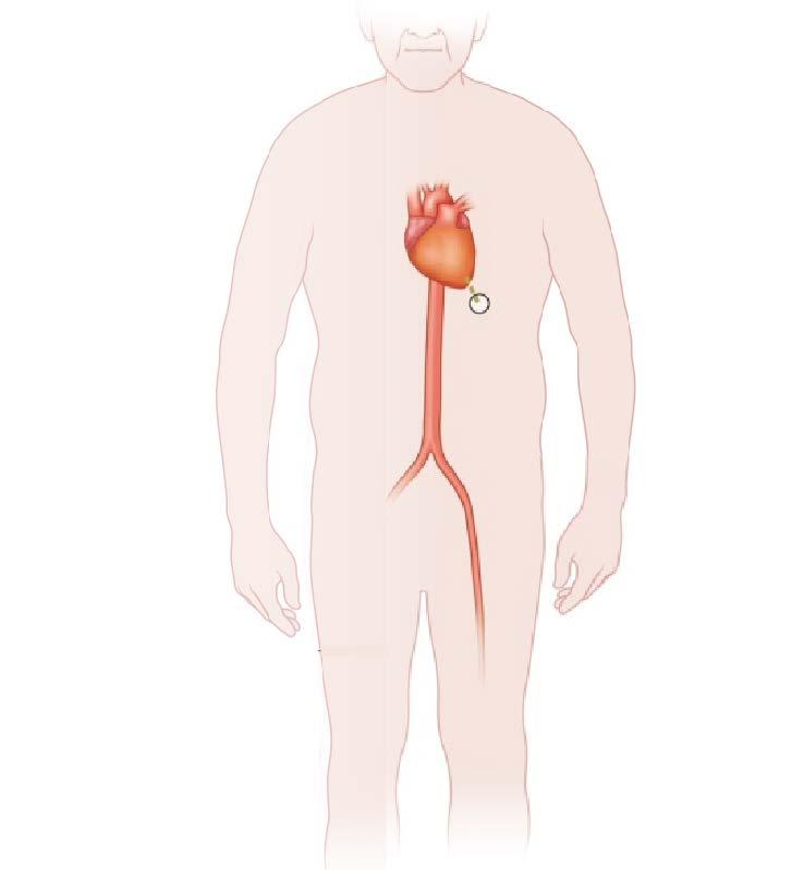 Transapical Aortic Valve Replacement A transapical aortic valve replacement is done through the apex of your heart. This is the lowest part or the tip of your heart.