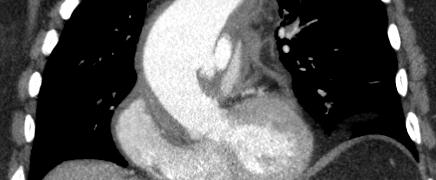 can lead to: IMH Aortic Dissection Perforation