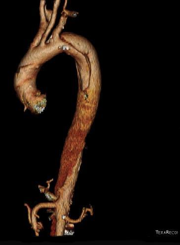 Type B Dissection Sub-Categories Acute Complicated Rupture Malperfusion Chronic Potential reasons for intervention Aneurysm degeneration Up to 30% become aneurysmal 1 Rupture Dissection extension