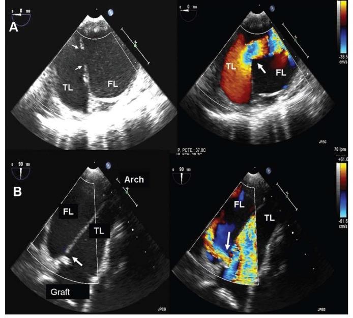 Medical therapy: In presence of small entries rather than one large entry Entry tear of aortic dissection visualized by 2-dimensional (left) and color-doppler (right) TEE Type B dissection with an