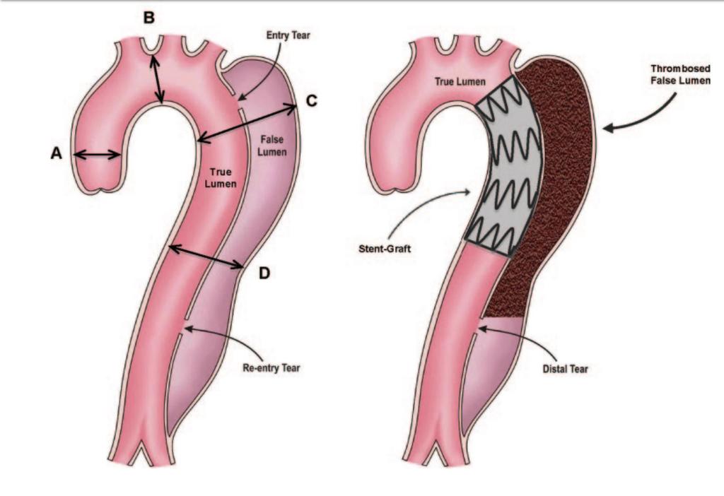 TEVAR induces aortic remodeling