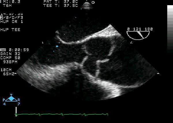 60 yo woman with severe chest pain