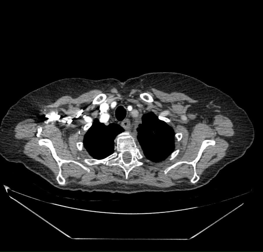CT scan -1 month postop