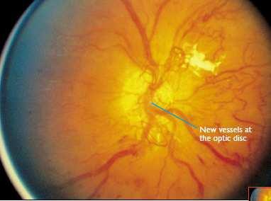 For Diffuse diabetic macular odema unresponsive to laser consider Anti- VEGF intra-vitreal injections into the eye eg Avastin, Maugen or Lucentis. Early trials very promising.
