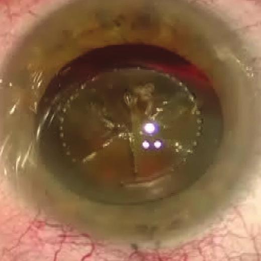 THE FIRST THREE CONDITIONS Shallow Anterior Chamber Eyes with a shallow anterior chamber or crowded anterior segment often have positive pressure from behind, making the anterior capsulorhexis