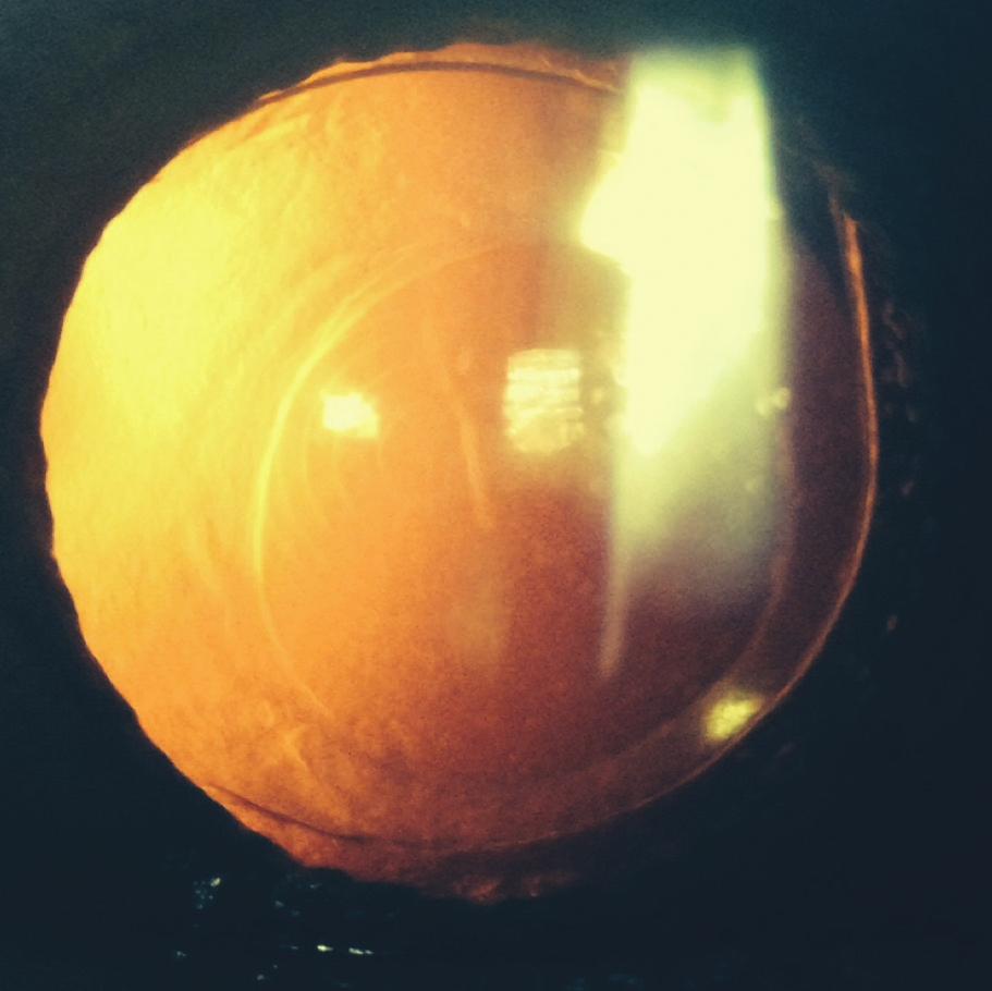 Figure 5. Anterior capsular contraction is evident. Figure 6. Six months after IOL exchange, the monofocal lens is well centered behind a laser-generated secondary anterior capsulotomy. Figure 7.