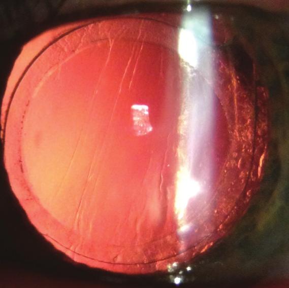 55 mm, and a lens thickness of 4.91 mm; corneal white to white measured 11.3 mm. Central corneal thickness measured 580 µm, and the endothelial cell count was 1,485 cells/mm 2.