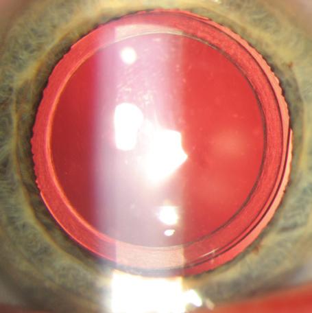 The procedure was uncomplicated, with mild central corneal edema noted on day 1. The cornea was clear and had returned to nearly preoperative thickness at the 2-week postoperative visit.