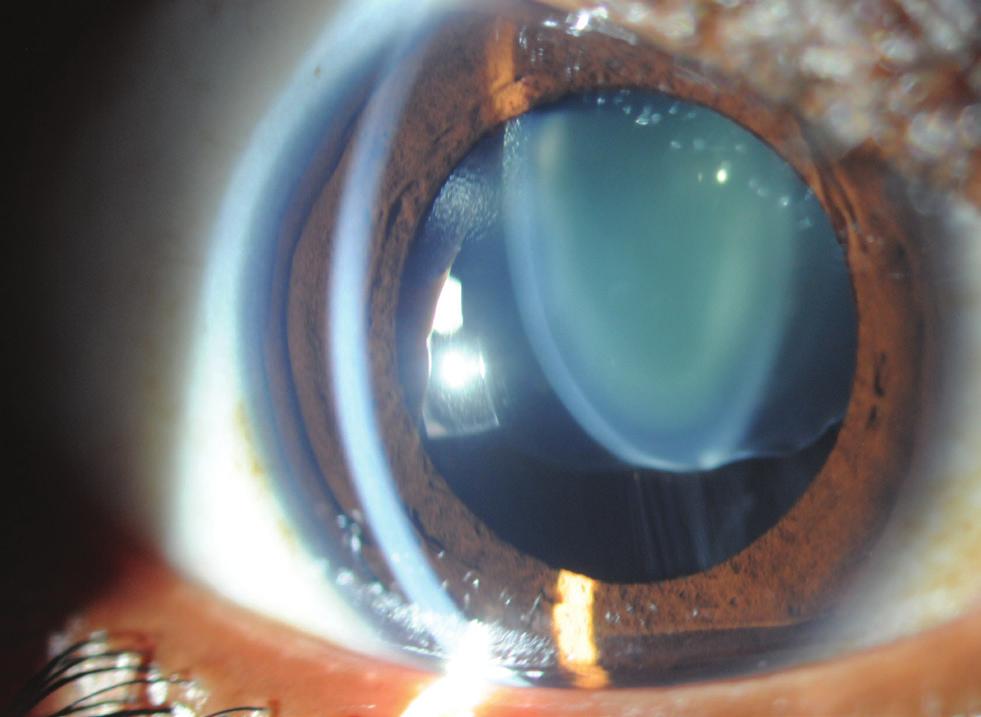 the most desirable. A radial tear in this type of case could be disastrous, because it will render the use of a capsular tension ring and the placement of the IOL in the bag virtually impossible.