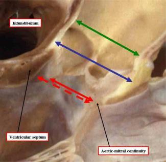 Sinus Green sinotubular junction Blue mid-sinus level (widest) Red basal cusp attachment Red dot echo annulus Loukas M,