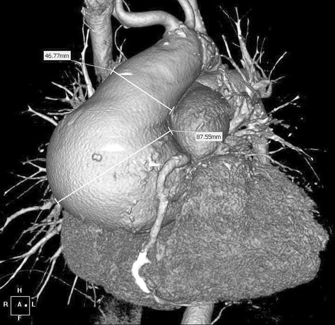 Sinus Largest diameter of root anyway Pear / onion in connective tissue disease (Marfan etc) Dilation in