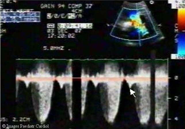 (figure 3). Figure 3 Continuous wave Doppler echocardiography with cursor placed in RVOT showing severe pulmonary stenosis (peak RVOT PG = 75.