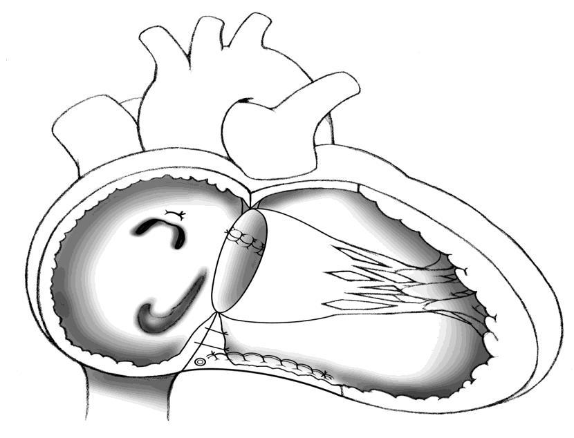 Ebstein`s anomaly : Cone Repair Antero-Superior and Inferior leaflets mobilised and detached from their position in RV and rotated clockwise and sutured to the septal margin of detached