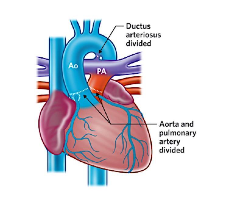 Aortic switch operation for TGA Operations for heart