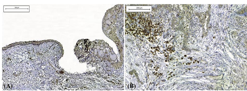 J Clin Exp Dent. 2018;10(6):e542-7. Ten (50%) of the 20 cases studied exhibited a predominantly mononuclear inflammatory infiltrate.
