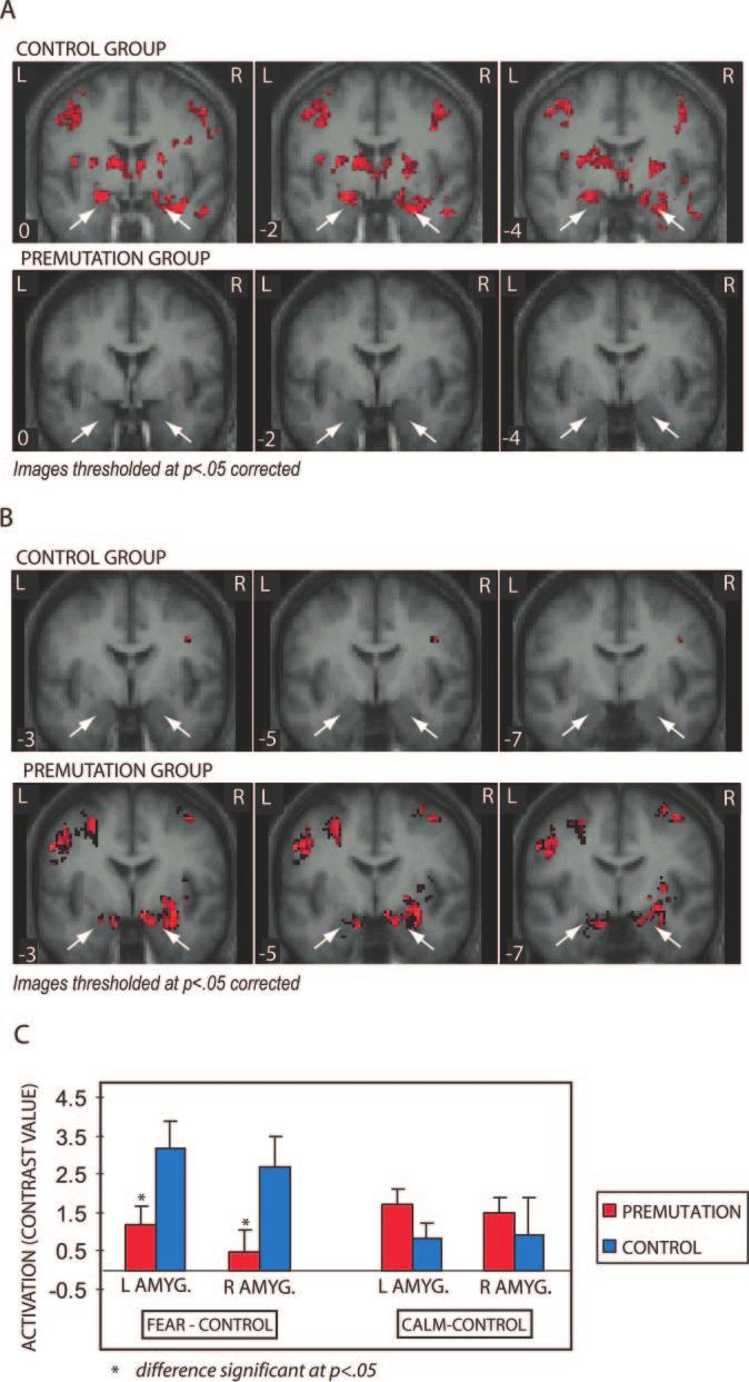Amygdala dysfunction in FMR1 premutation Brain (2007), 130, 404 416 411 Fig. 4 Regions of activation overlaid on the average normalized T1 structural images.