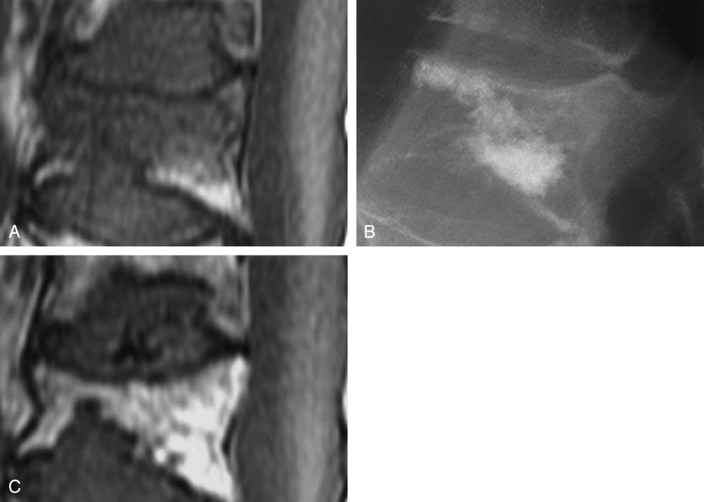 AJNR: 26, June/July 2005 VERTEBROPLASTY 1597 FIG 1. Additional height loss after VP. A, T1-weighted MRI before L1 VP shows vertebral compression and marrow edema.