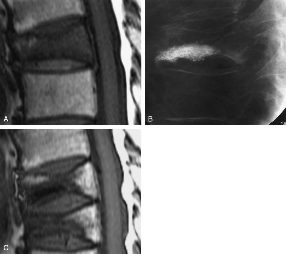 AJNR: 26, June/July 2005 VERTEBROPLASTY 1599 FIG 3. Persistent marrow edema after VP. A, Preprocedure T1-weighted MRI shows partial compression of T8 with severe edema.