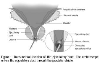 Transurethral incision of the Ejaculatory Duct with Holmium laser 11 patients Azoospermia and low ejaculate volume Midline