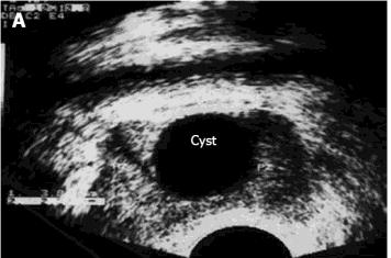 Diagnostic Methods Transrectal ultrasound