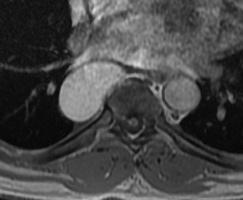 Even in the paravertebral compartment, neurenteric cysts are rare in the absence of a vertebral body segmentation
