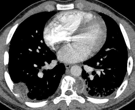 Non-neoplastic Disease Axial CT angiogram and coronal T1W MR of a 21-year-old male with coccidioidomycosis reveal a