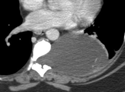 Lateral Thoracic Meningocele Contrast-enhanced axial CT better defines the lesion as a cystic mass arising from the spinal canal and expanding the left neural foramen.