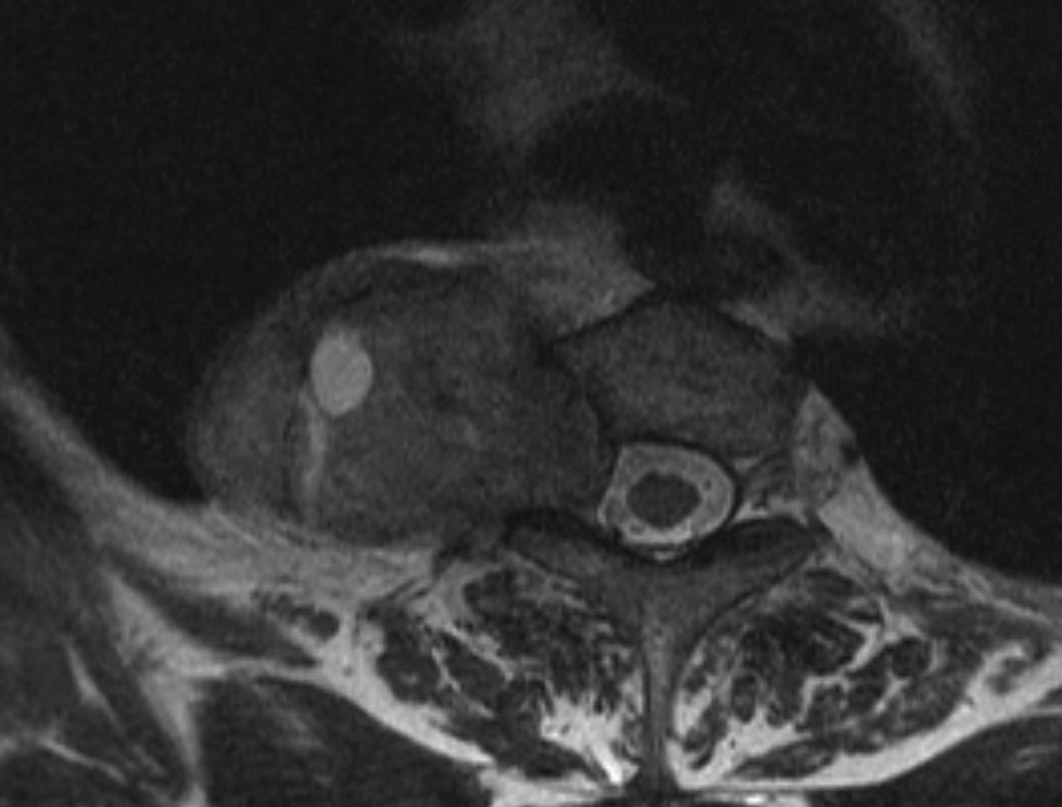 Neurogenic Tumors Axial non-contrast chest CT demonstrates a right