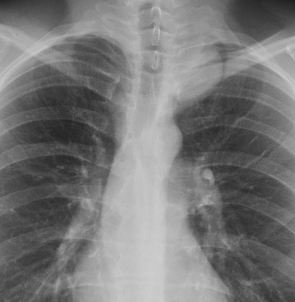 Neurogenic Tumors Coned-down PA and lateral chest radiographs demonstrate