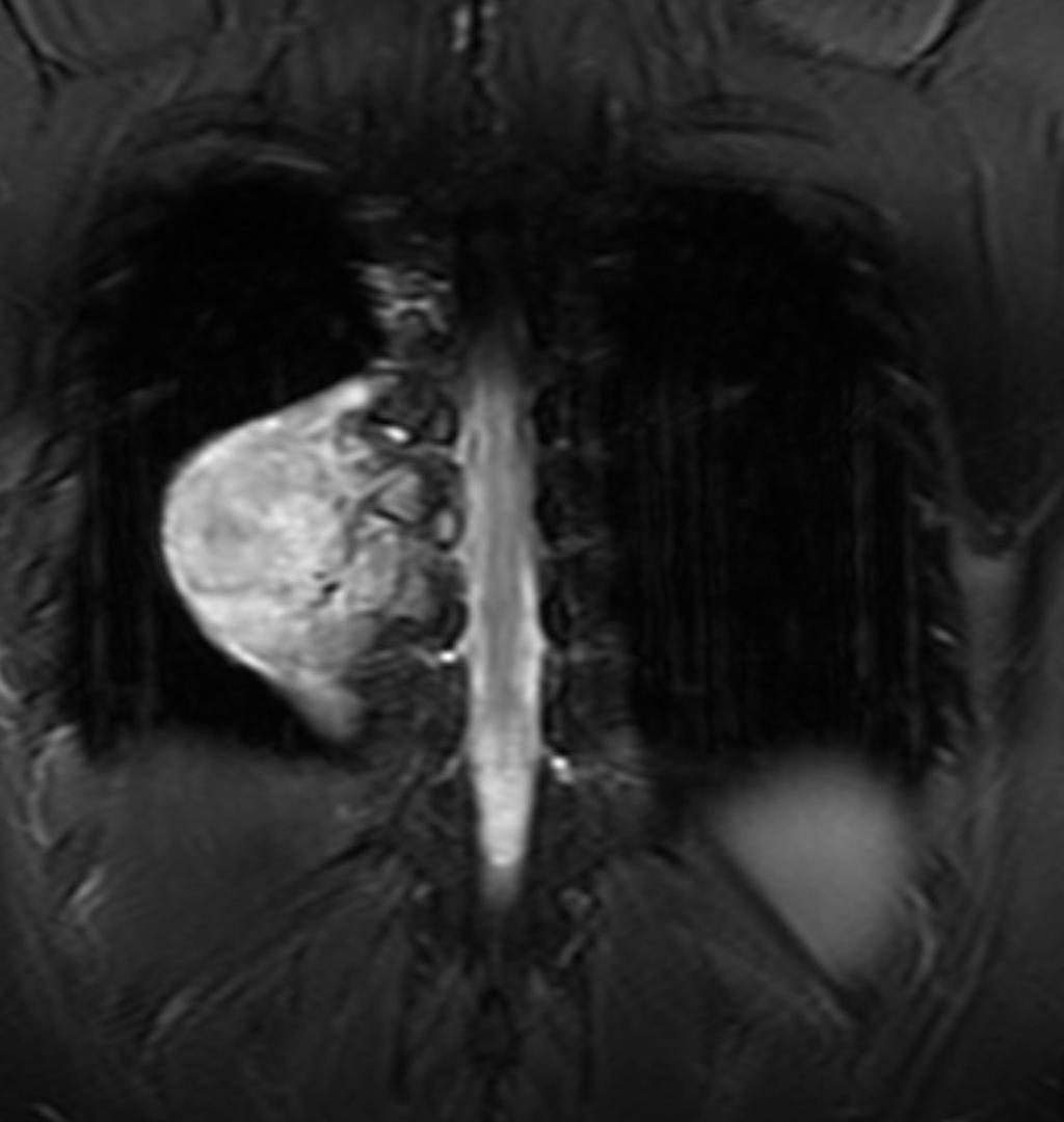 Coronal T2WI with fat saturation shows a right paravertebral mass spanning multiple vertebral segments.