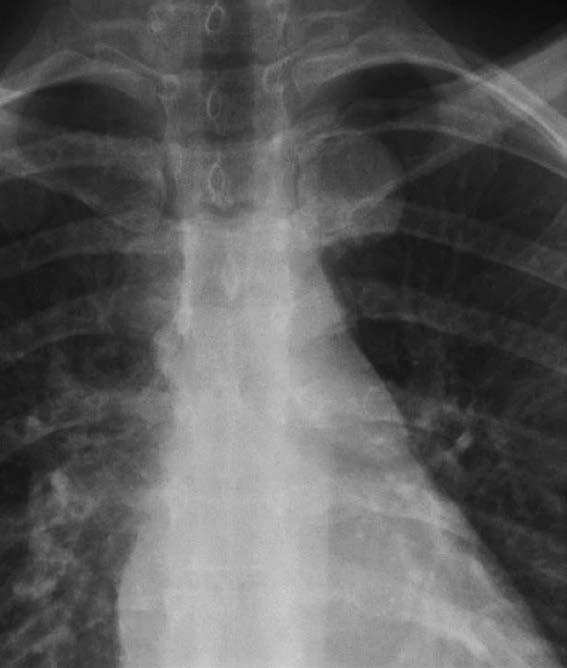 Osseous Tumors Coned-down PA chest radiograph shows a smoothly marginated mass in the left posterior mediastinum, projected behind the left promixal clavicle.